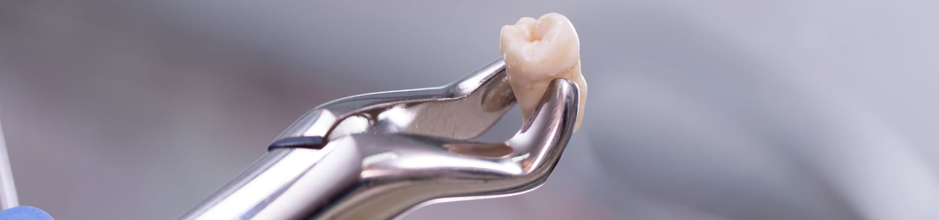 Wisdom Teeth Extractions - Mirra Periodontal & Implant Center